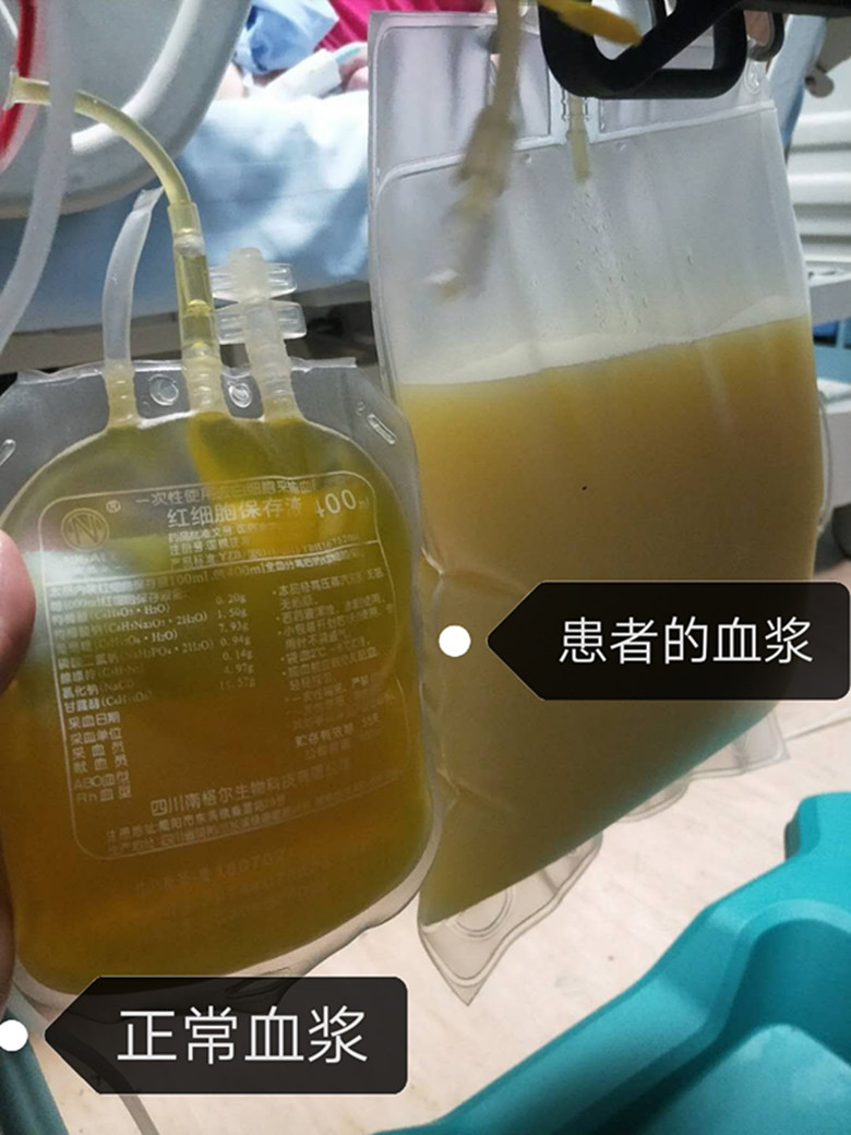 看，这血黏成这样血滤器都被血脂堵死了--漳州市中医院ICU重症胰腺炎救治成功记
