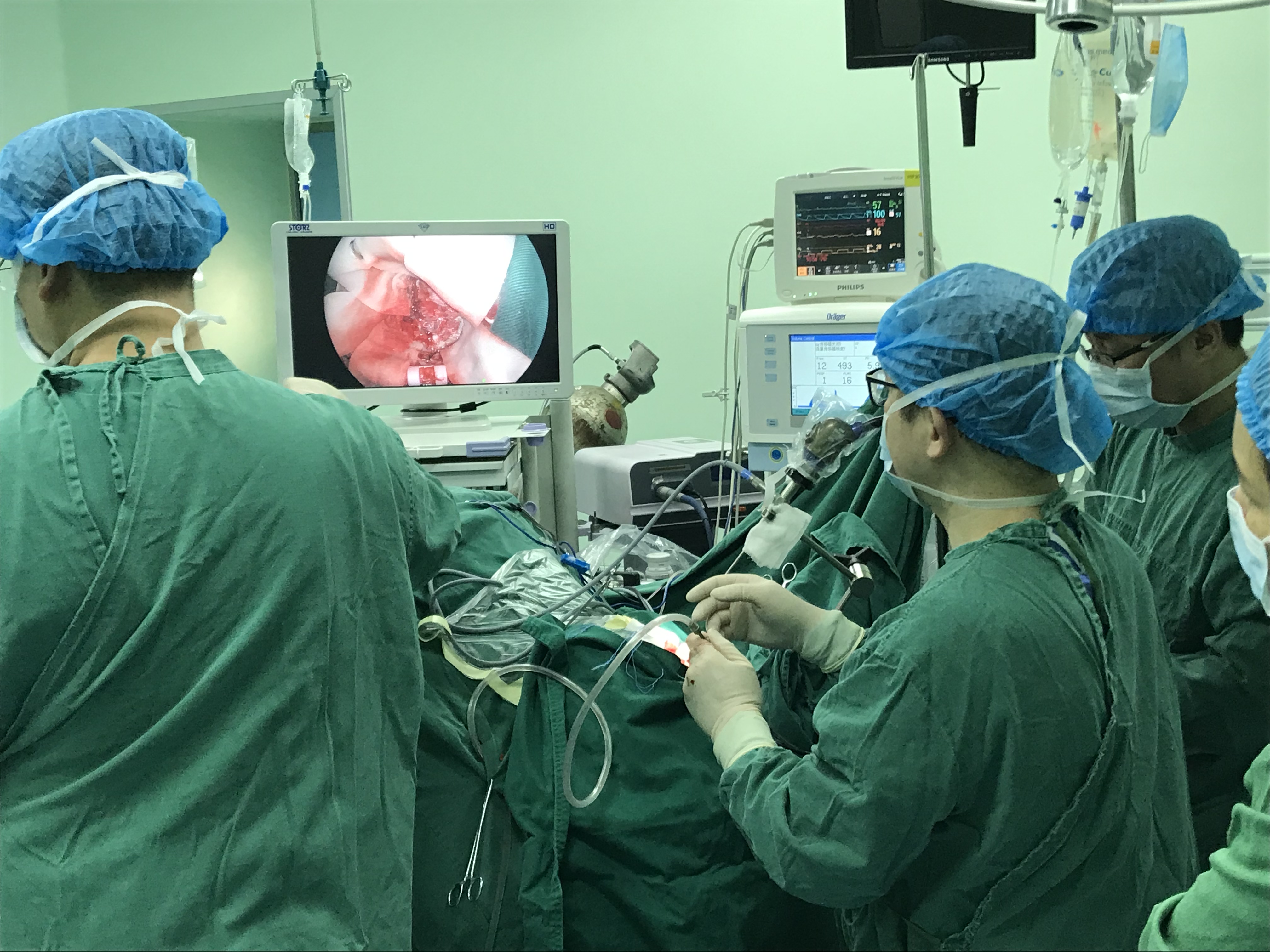 漳州市中医院神经外科成功完成一例 神经内镜下镰旁脑膜瘤切除术