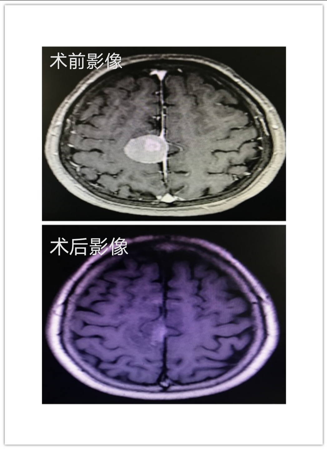 漳州市中医院神经外科成功完成一例 神经内镜下镰旁脑膜瘤切除术