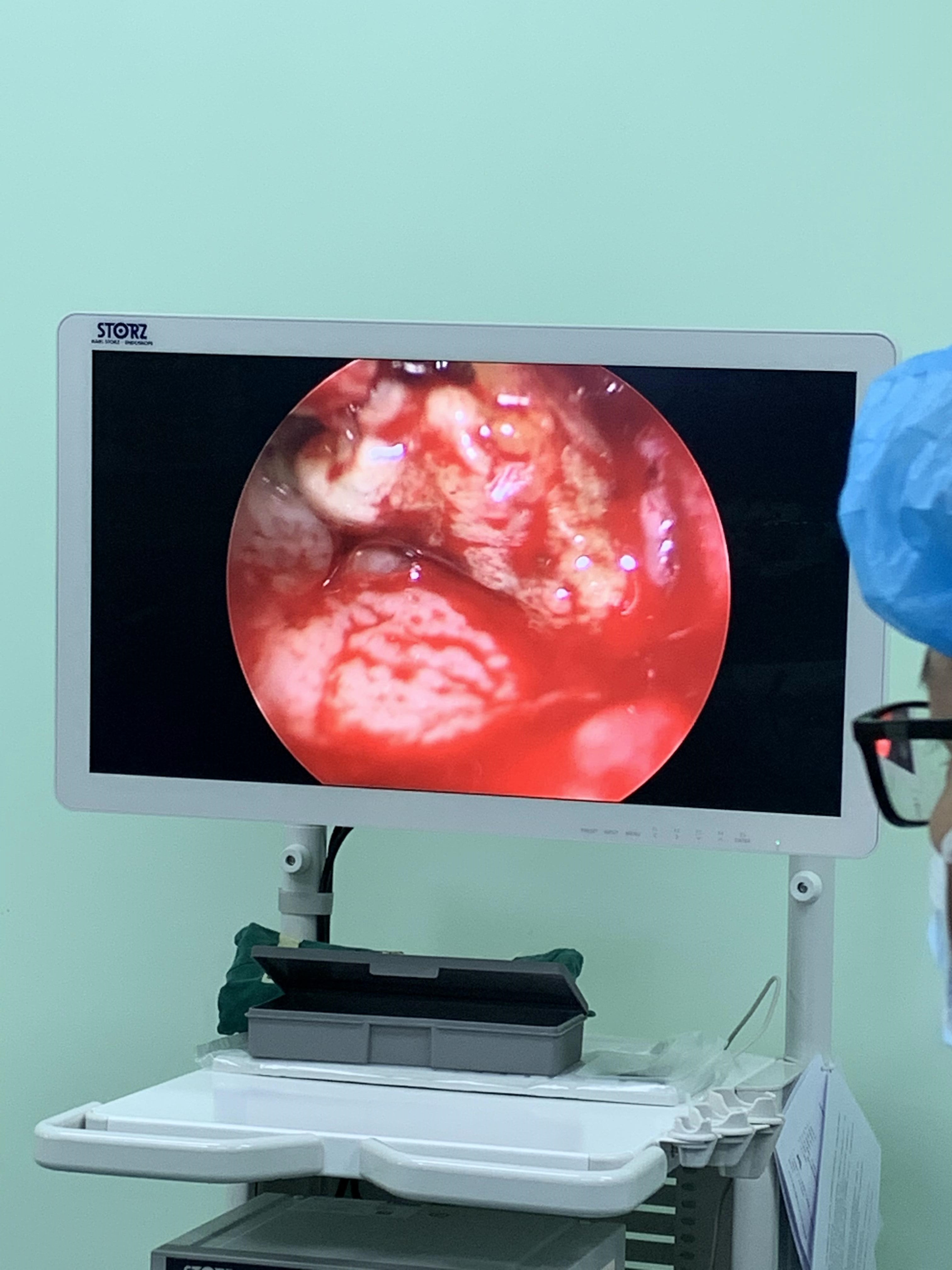 鼻内镜手术治疗——难治性鼻病患者的福音