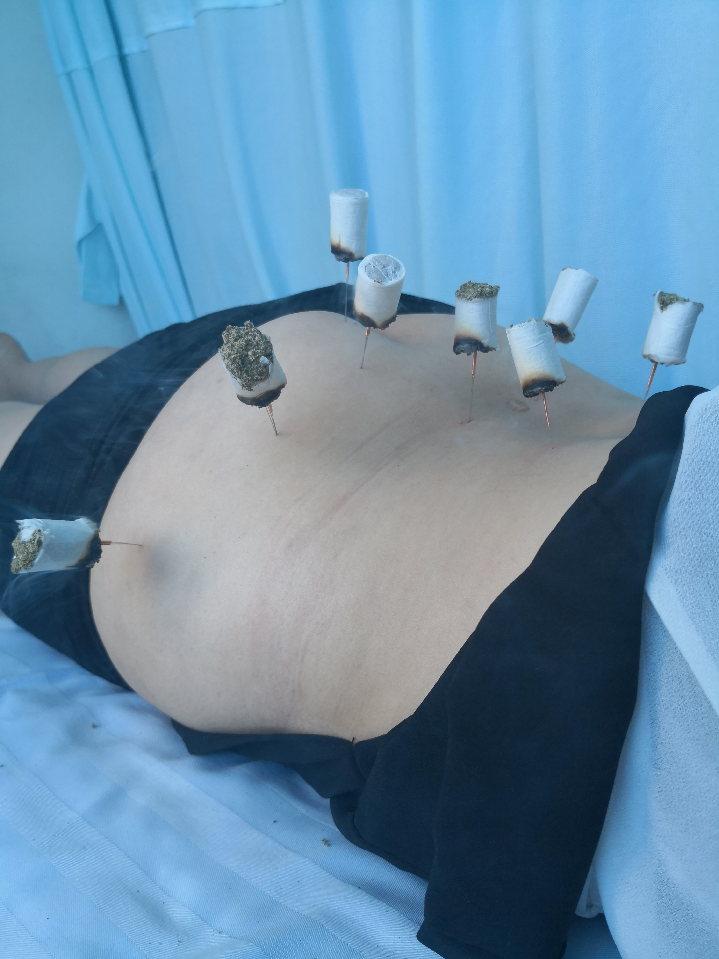 特色疗法赢信任 妙手施治创佳话