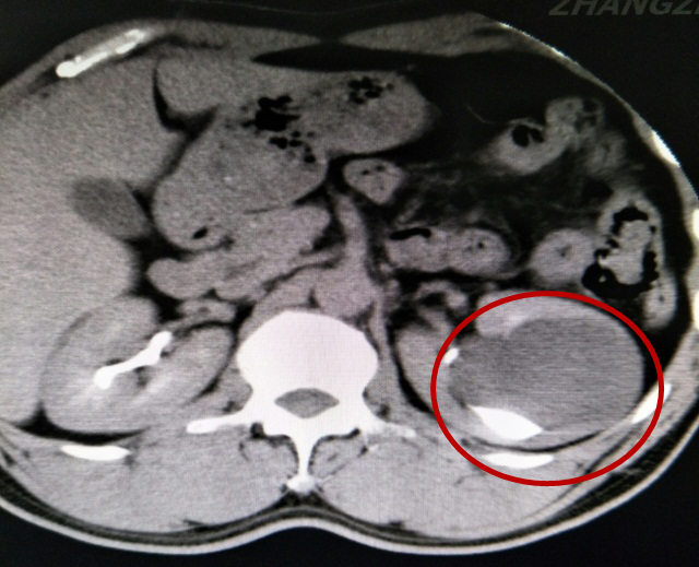 赞！不用开刀就能把肾脏内8公分大的囊肿取出来