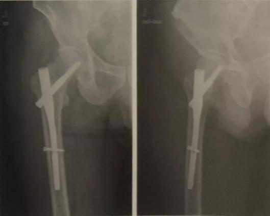 骨折了，医生为什么不马上给我动手术？