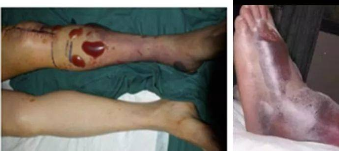 骨折了，医生为什么不马上给我动手术？