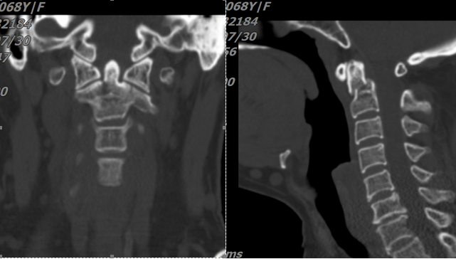 突破手术“禁区”成功实施颈寰枢椎内固定手术