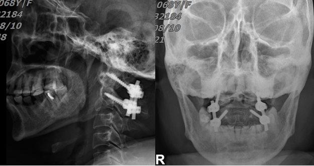 突破手术“禁区”成功实施颈寰枢椎内固定手术