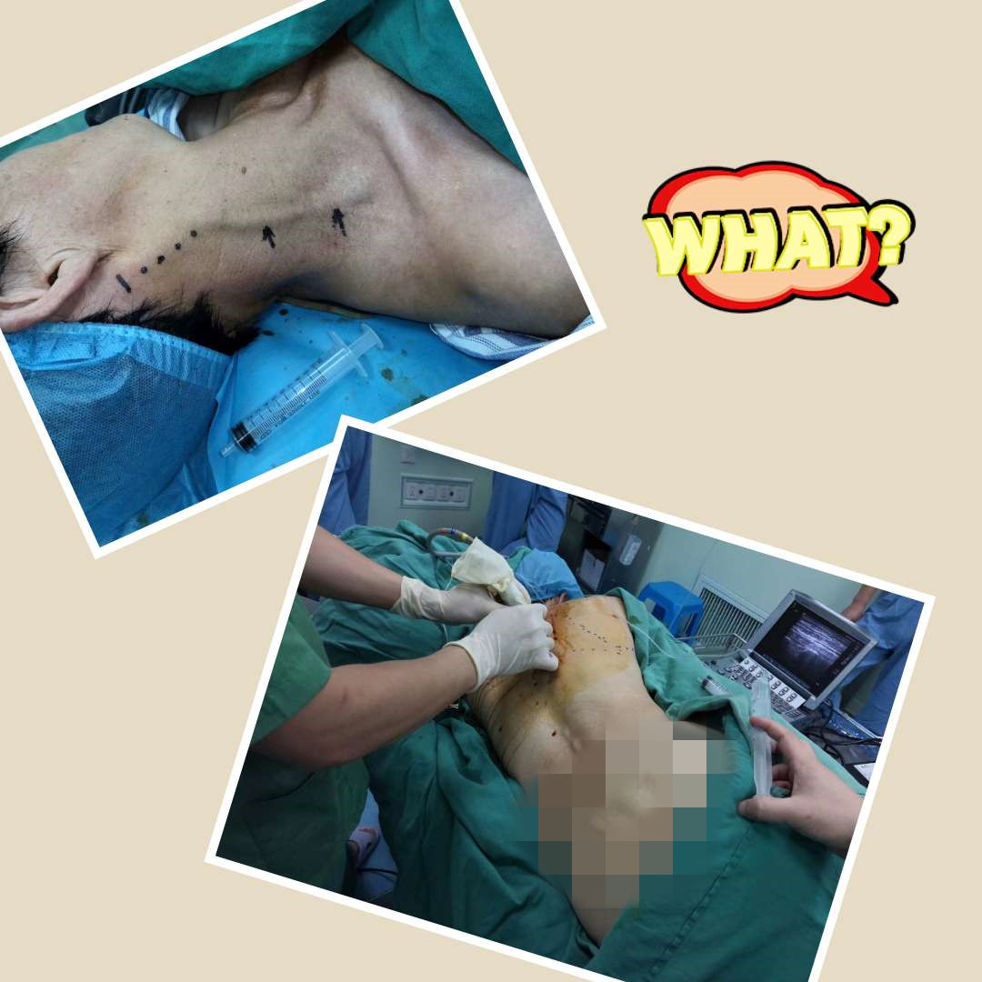 精准麻醉助力肩胛骨骨折内固定术顺利实施