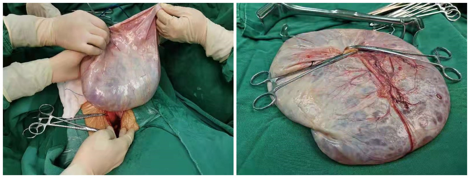 漳州市中医院妙手摘除百岁老人巨大卵巢囊肿