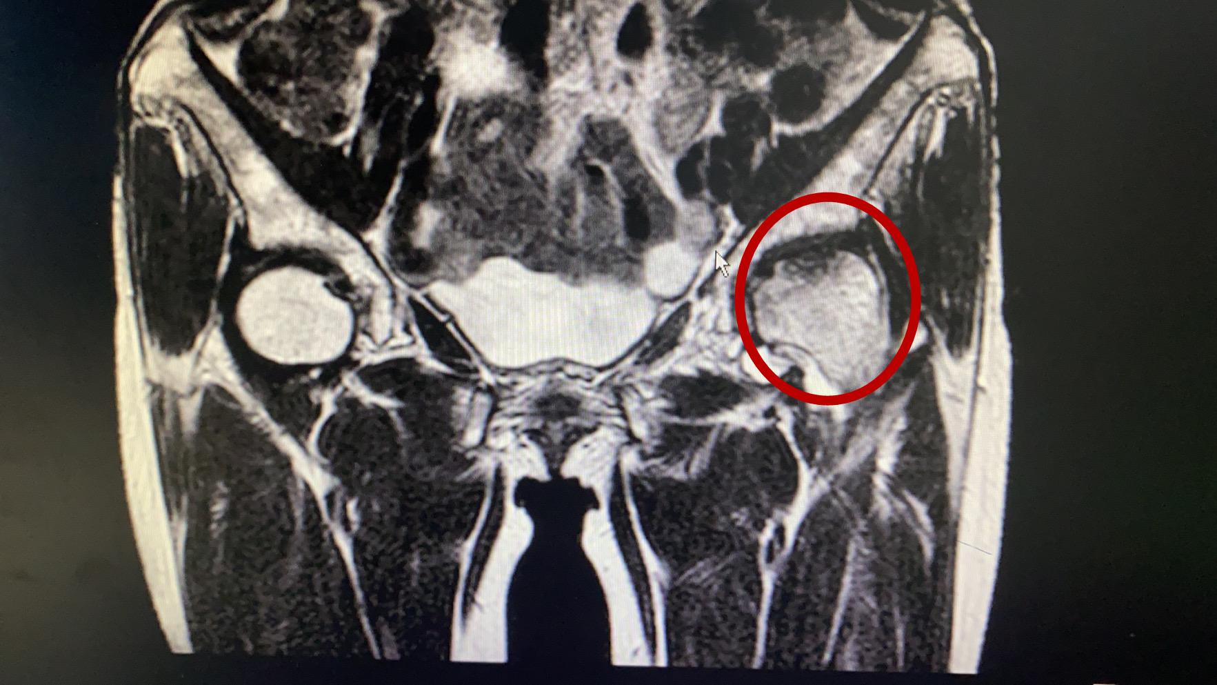 “不死癌症”股骨头坏死患者治疗新希望