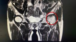 “不死癌症”股骨头坏死患者治疗新希望 “不死癌症”股骨头坏死患者治疗新希望