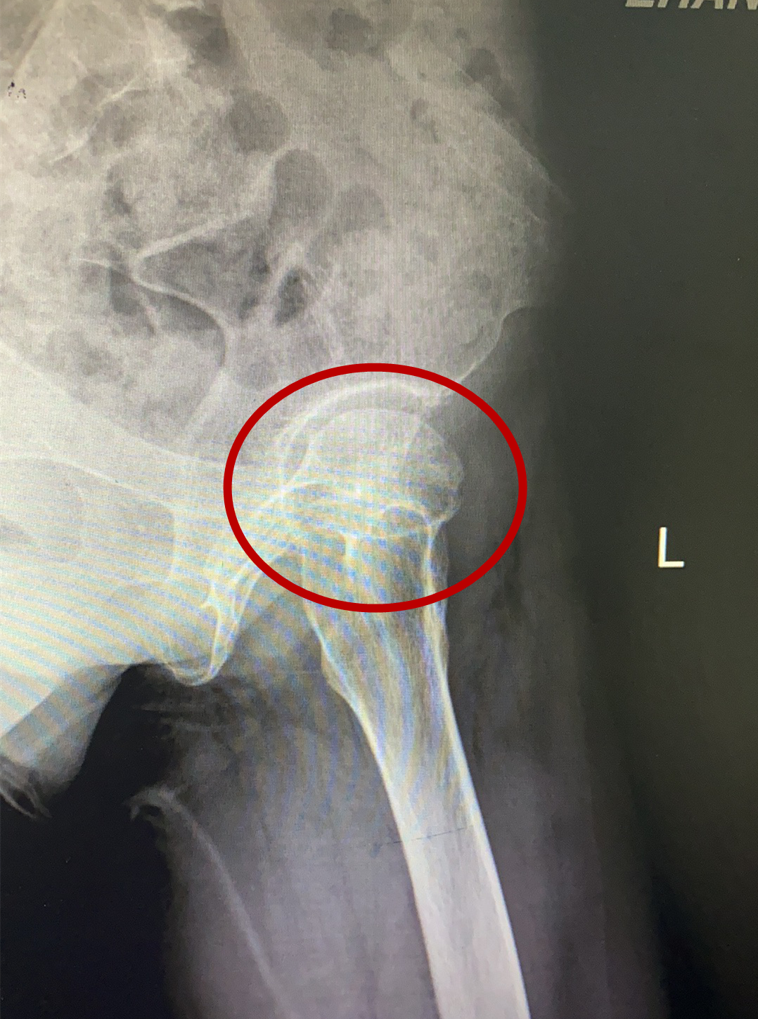 “不死癌症”股骨头坏死患者治疗新希望