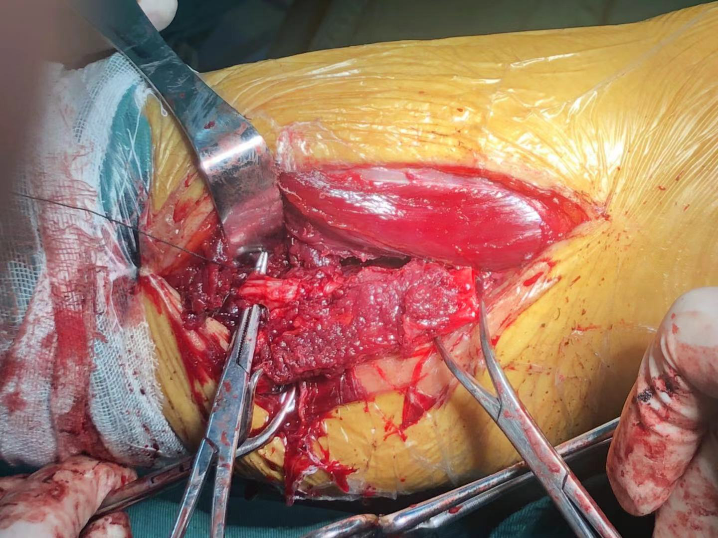 “不死癌症”股骨头坏死患者治疗新希望