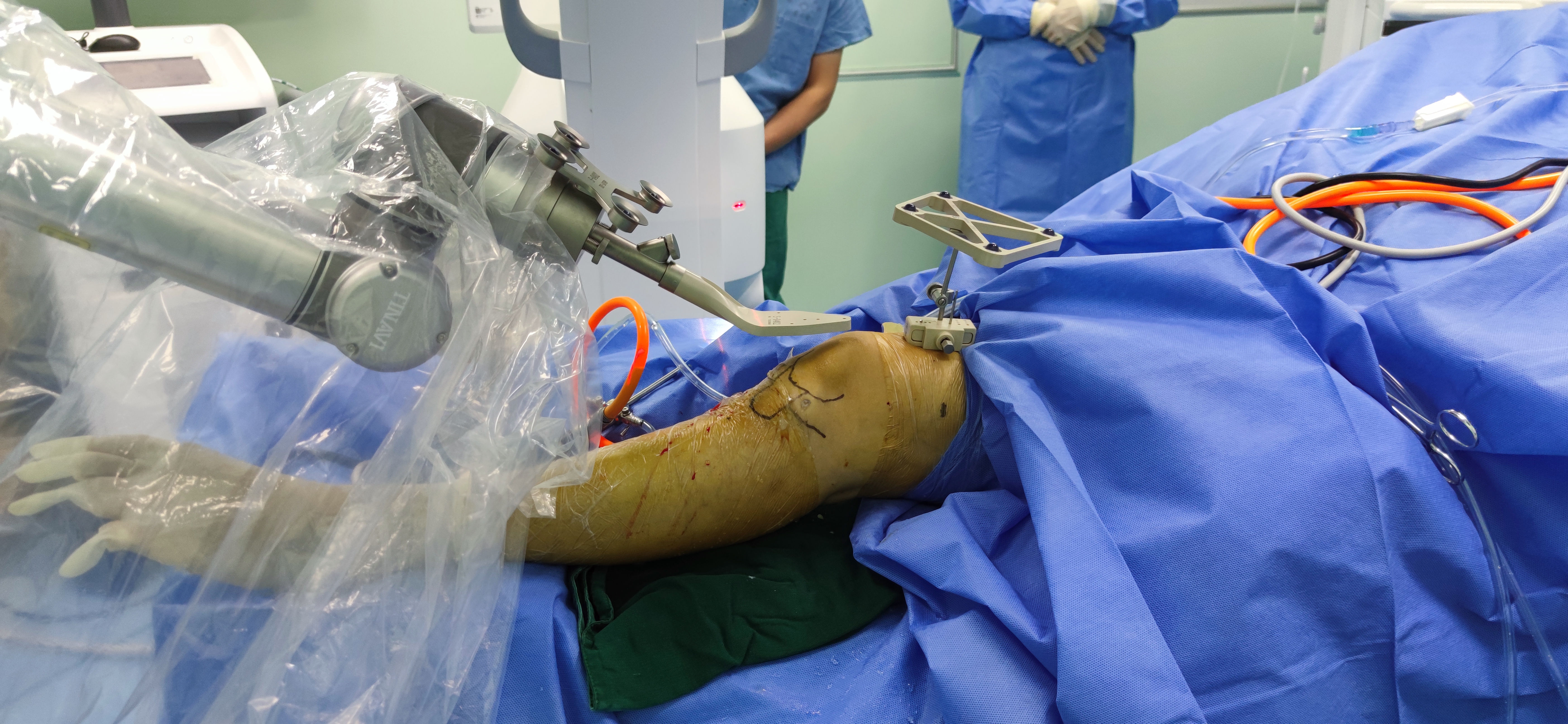 首例机器人辅助前交叉韧带重建术在我院成功实施