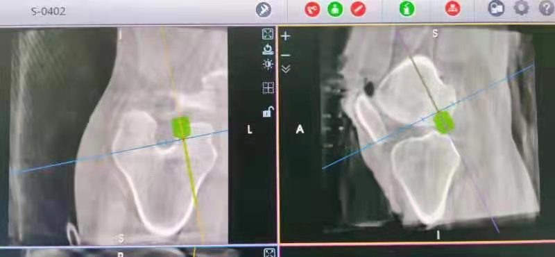 首例机器人辅助前交叉韧带重建术在我院成功实施