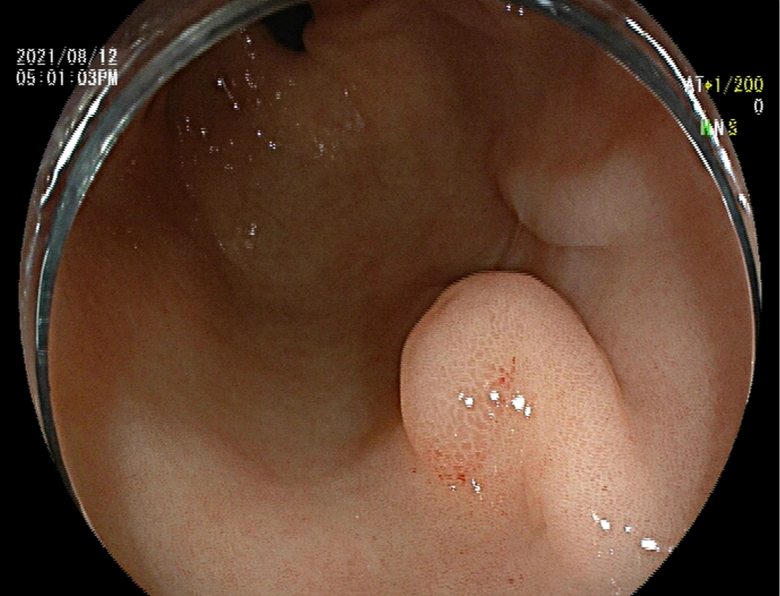 小小内镜显神通  中西结合瘥顽疾