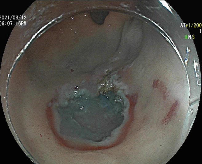 小小内镜显神通  中西结合瘥顽疾