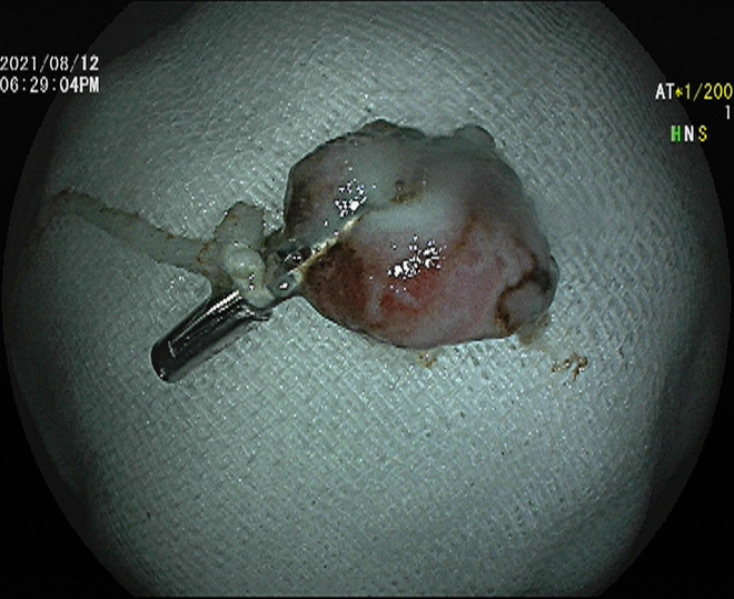 小小内镜显神通  中西结合瘥顽疾