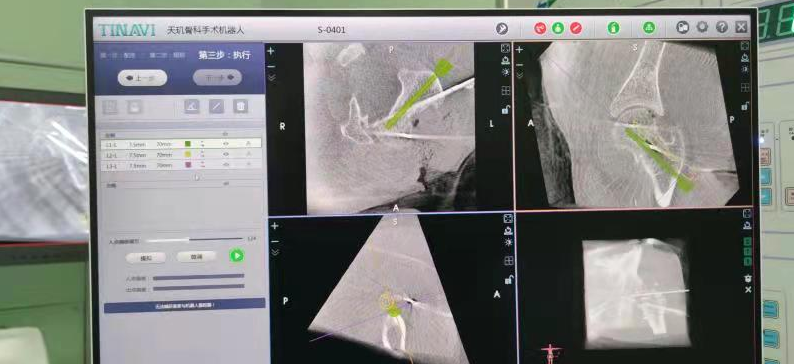 骨科机器人|精准“导航”告别“暗箱操作”