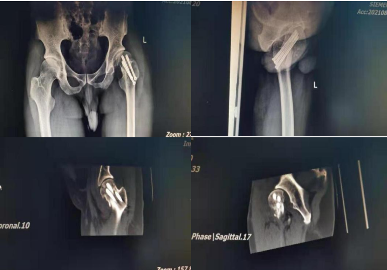 骨科机器人|精准“导航”告别“暗箱操作”