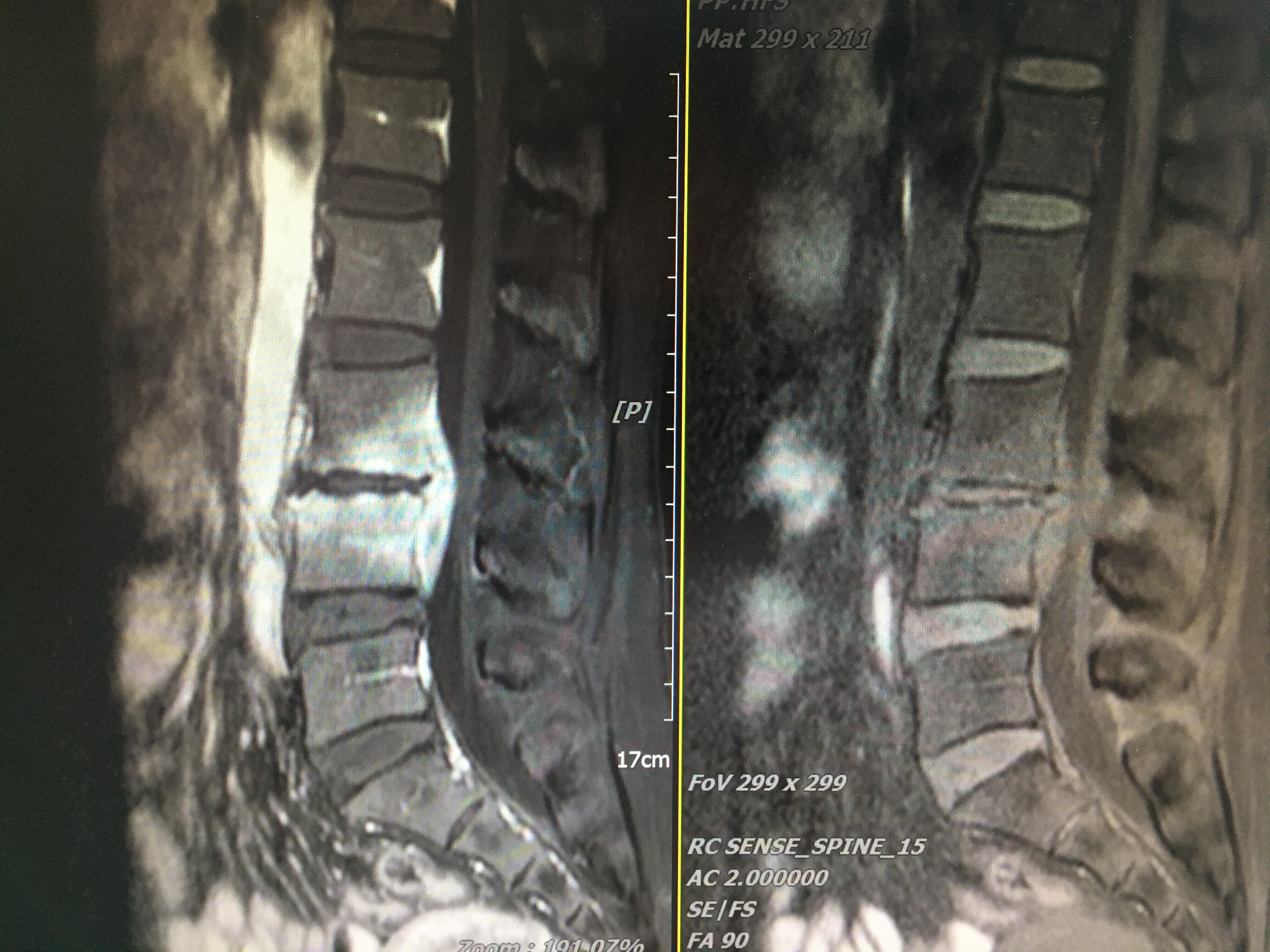 Olif手术入路+天玑骨科机器人治疗化脓性脊柱炎