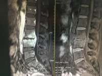 Olif手术入路+天玑骨科机器人治疗化脓性脊柱炎 Olif手术入路+天玑骨科机器人治疗化脓性脊柱炎
