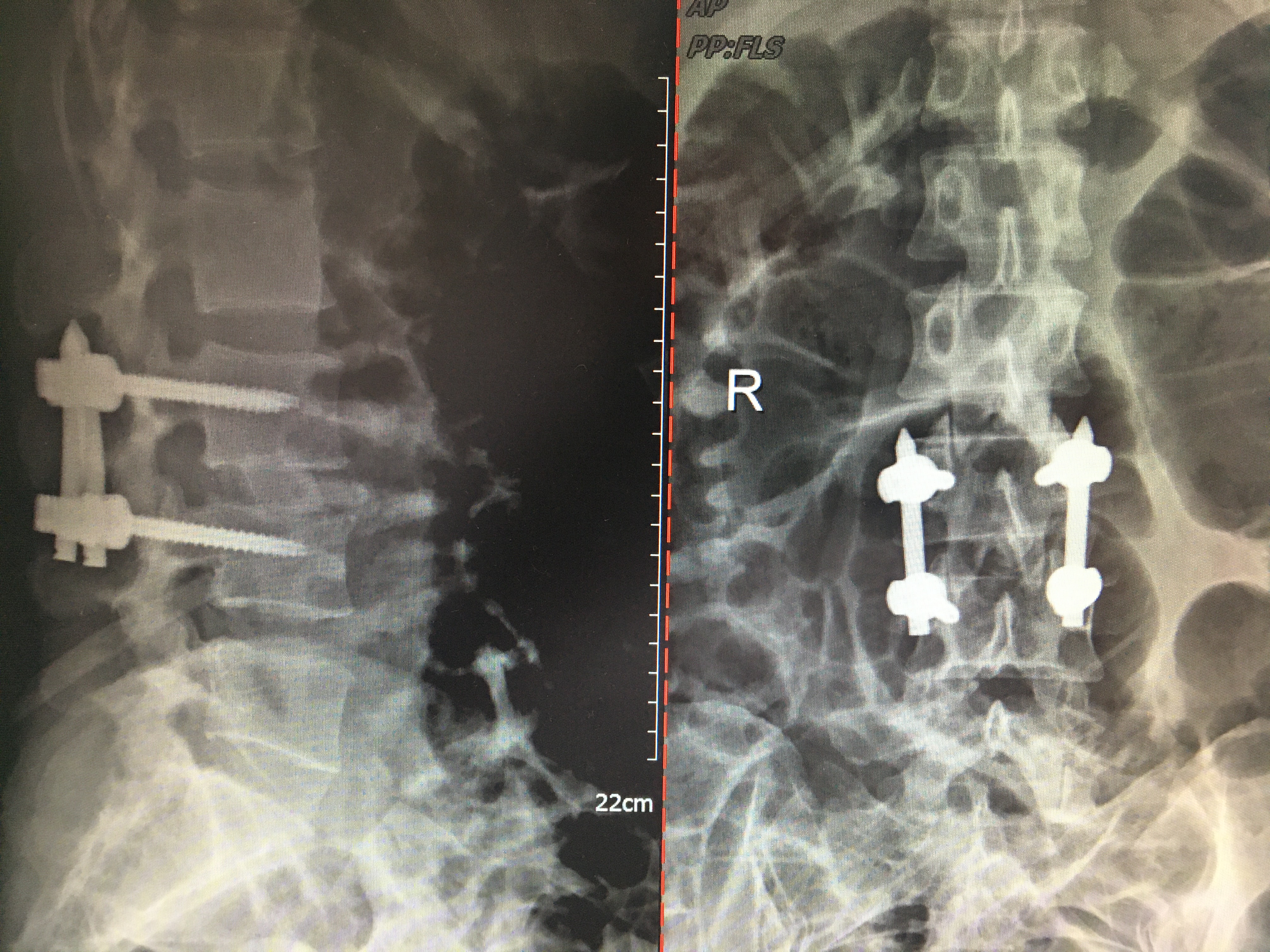 Olif手术入路+天玑骨科机器人治疗化脓性脊柱炎