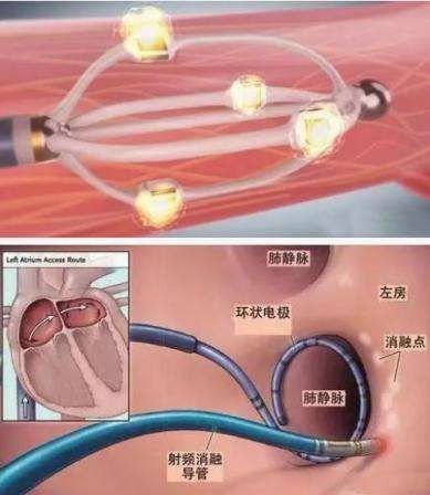 关注心房颤，预防脑卒中— —从”心”出发