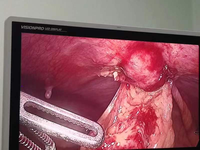 我院泌尿外科成功开展首例腹腔镜下脐尿管囊肿切除术 我院泌尿外科成功开展首例腹腔镜下脐尿管囊肿切除术