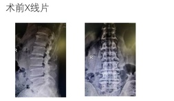 漳州市中医院率先在漳州成功开展UBE(单边双通道内镜技术)微创手术