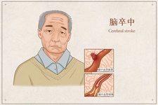 卒中识别早，救治效果好！| 第18个世界卒中