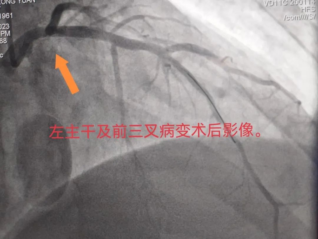 术后.jpg