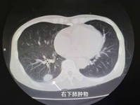 巧查细诊现双癌，精准施治妙回春